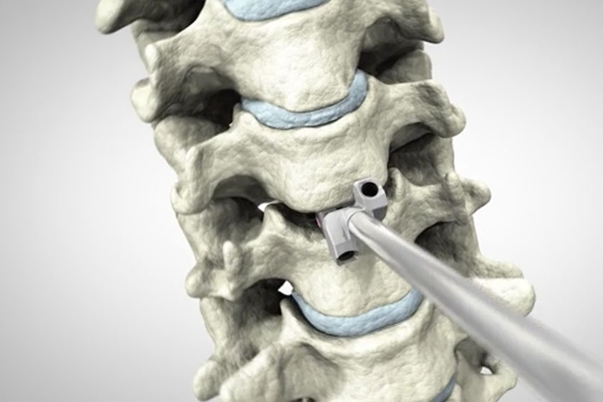 Minimally Invasive Cervical Fusion DTRAX Carl Spivak, MD