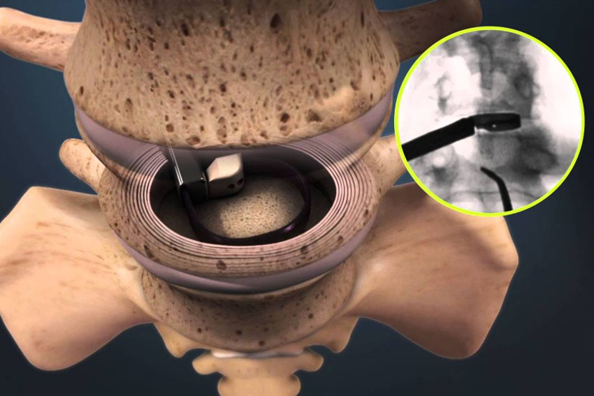 procedureslumbarfusion Carl Spivak, MD Executive