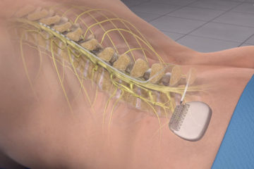 Spinal Cord Stimulation