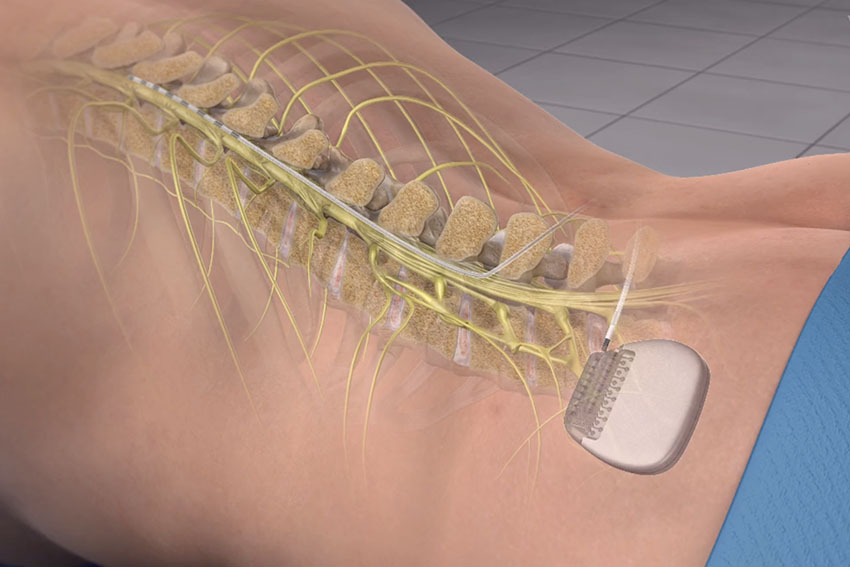 dorsal column stimulator surgery