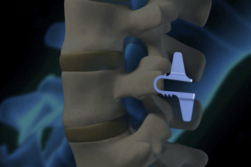 Coflex Spinal Implant