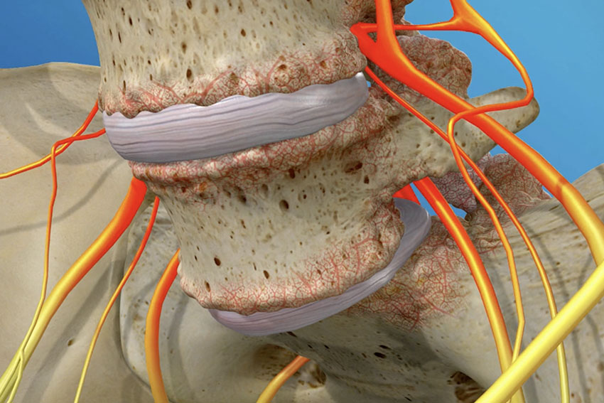 Cervical Spine Bone Spurs