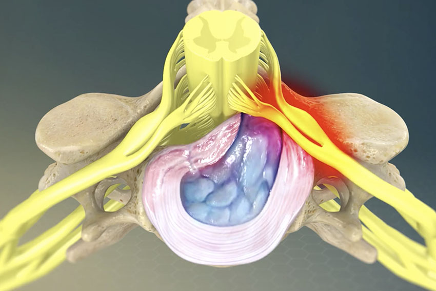 lower-back-left-side-pain-common-causes-of-lower-back-pain-left-side