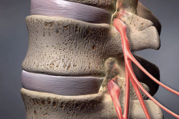 Spinal Stenosis (Narrowing)