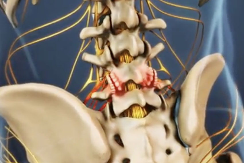 spine arthritis