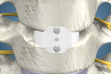 Anterior Cervical Discectomy