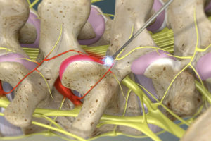 Thermal Ablation