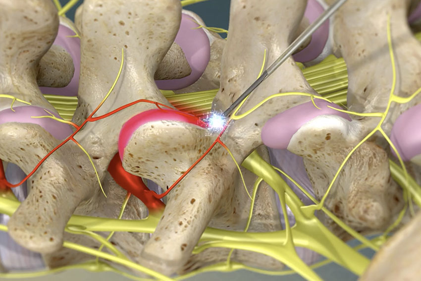 Facet Thermal Ablation Carl Spivak, MD Executive Spine