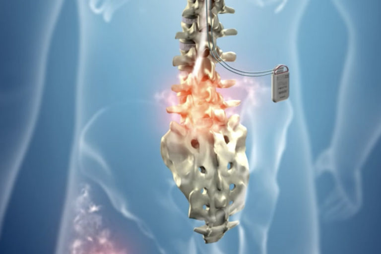 procedureshfstim Carl Spivak, MD Executive Spine Surgery