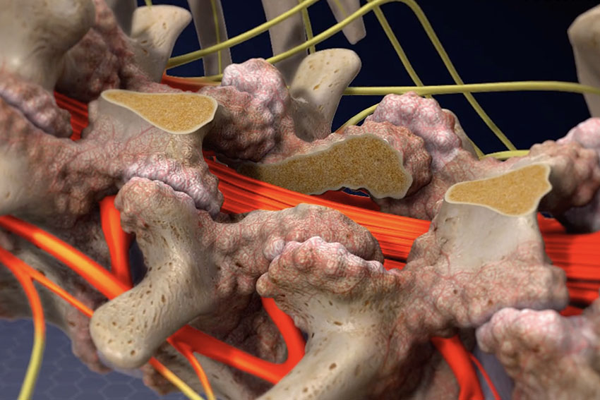 Lumbar Laminectomy Surgery Procedure Steps