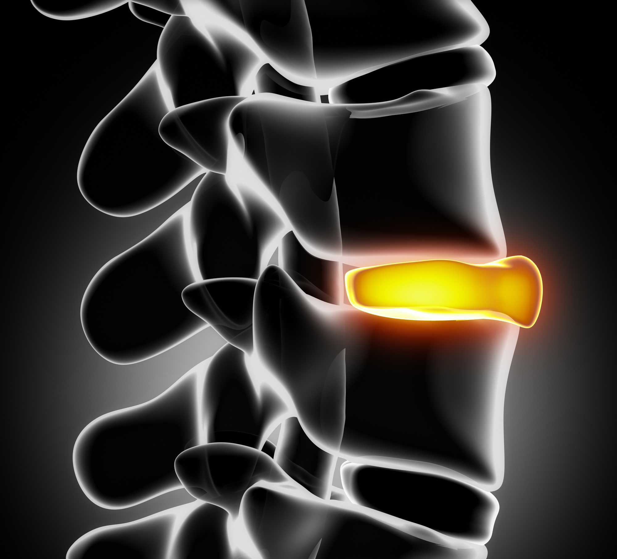 bulging disc treatment