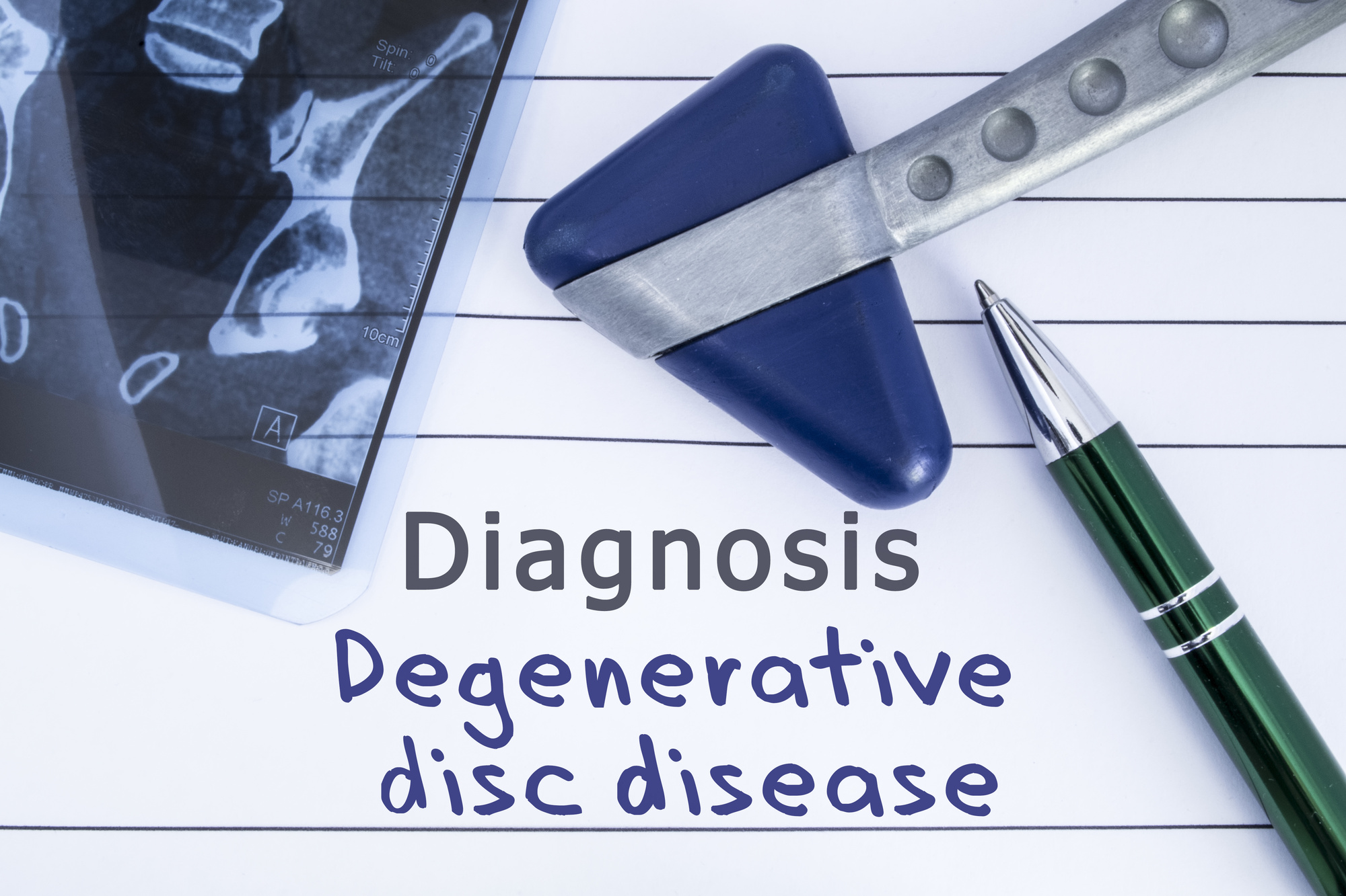 degenerative disc disease treatment