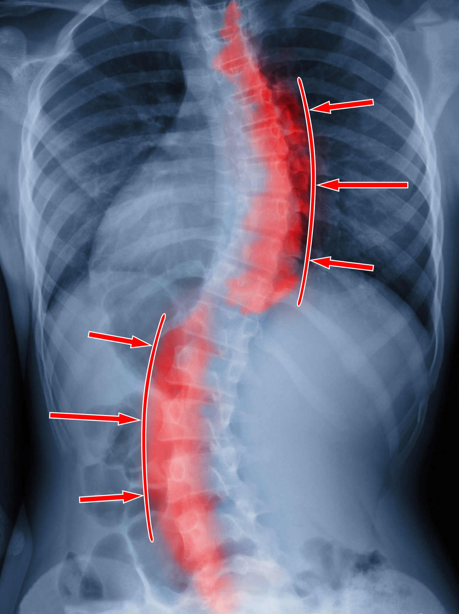 spinal fusion surgery