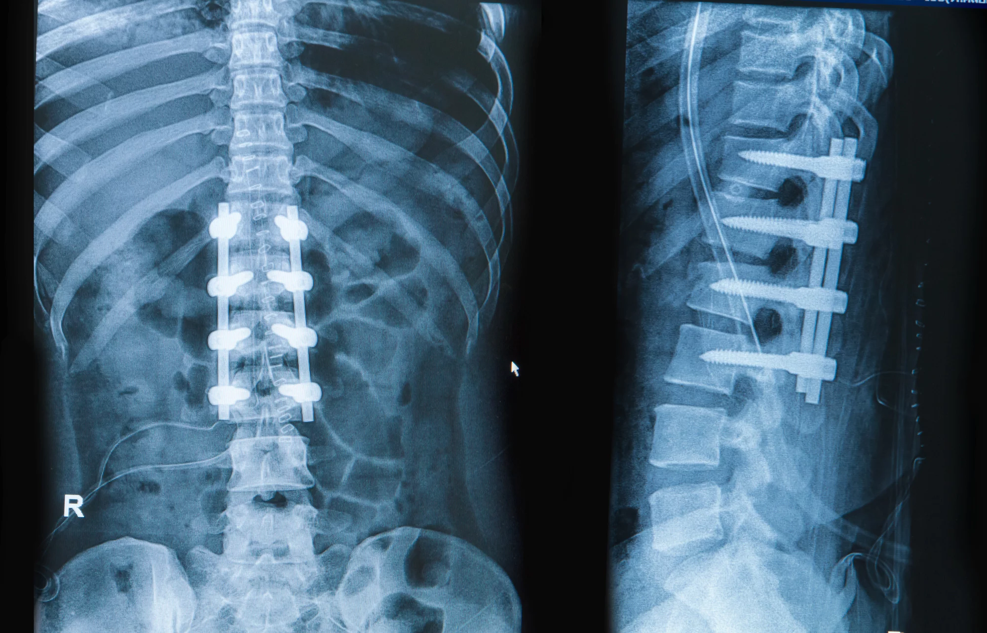 spinal fusion recovery