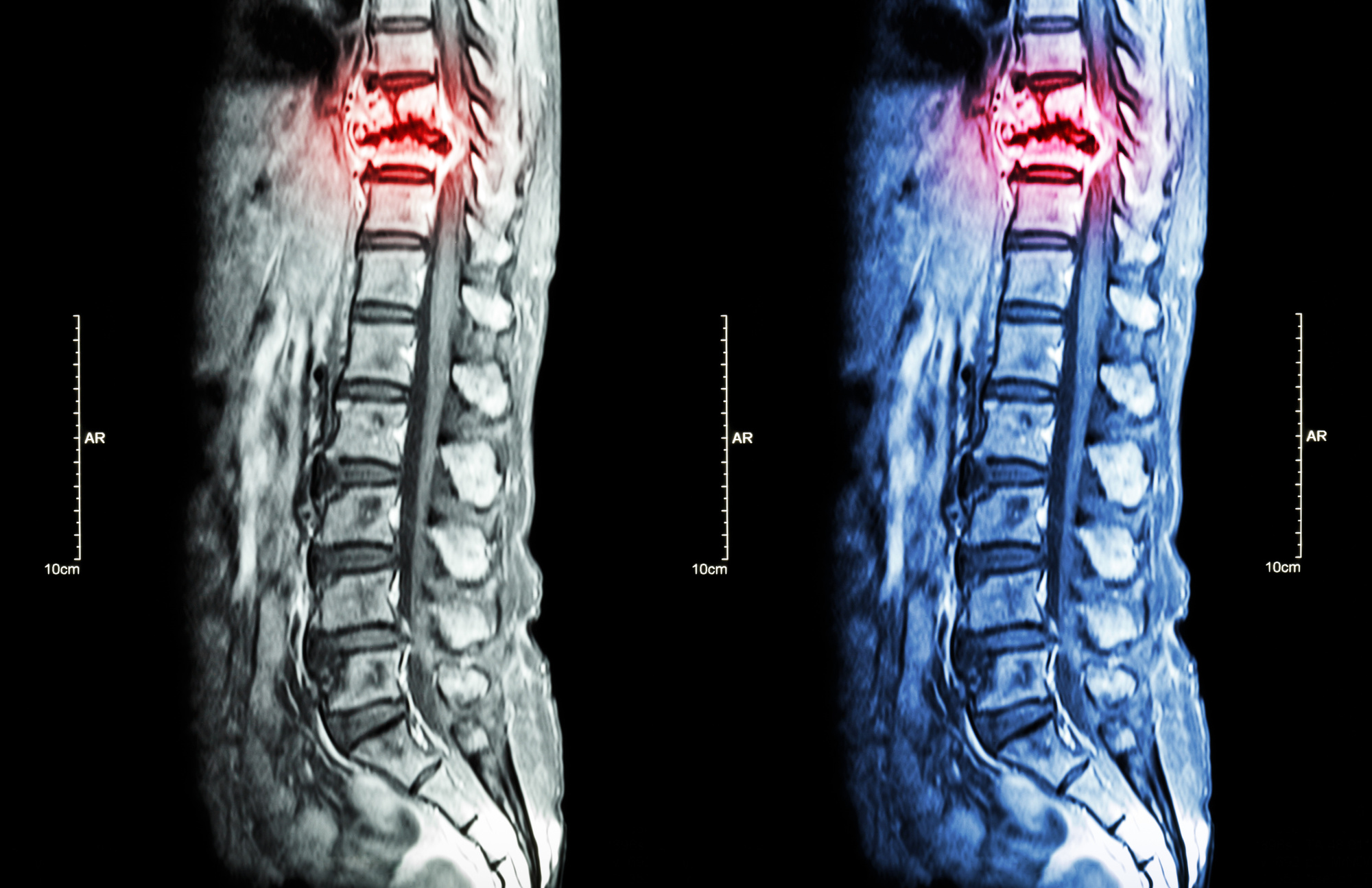 spinal surgery